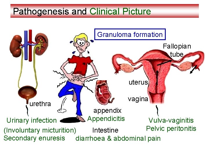 Pathogenesis and Clinical Picture Granuloma formation Fallopian tube uterus urethra vagina appendix Appendicitis Urinary