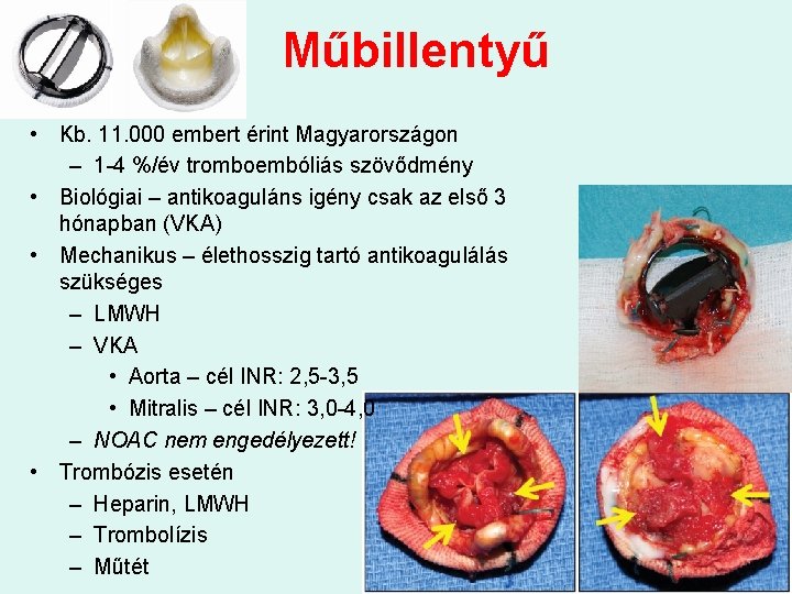 Műbillentyű • Kb. 11. 000 embert érint Magyarországon – 1 -4 %/év tromboembóliás szövődmény