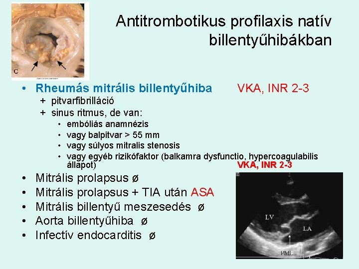 Antitrombotikus profilaxis natív billentyűhibákban • Rheumás mitrális billentyűhiba VKA, INR 2 -3 + pitvarfibrilláció