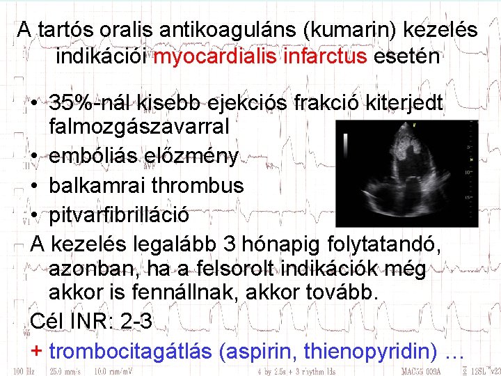 A tartós oralis antikoaguláns (kumarin) kezelés indikációi myocardialis infarctus esetén • 35%-nál kisebb ejekciós