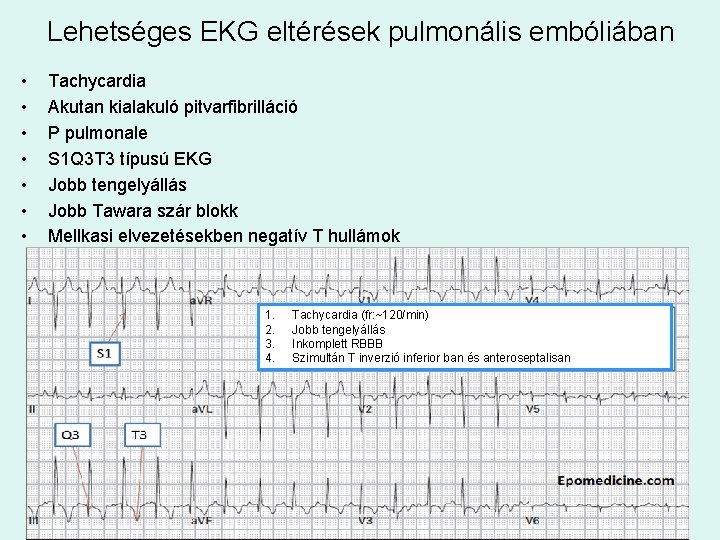 Lehetséges EKG eltérések pulmonális embóliában • • Tachycardia Akutan kialakuló pitvarfibrilláció P pulmonale S