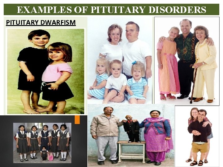EXAMPLES OF PITUITARY DISORDERS PITUITARY DWARFISM 