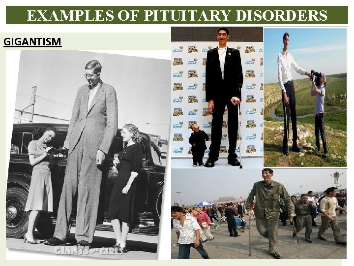 EXAMPLES OF PITUITARY DISORDERS GIGANTISM 