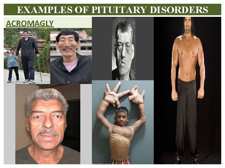 EXAMPLES OF PITUITARY DISORDERS ACROMAGLY 