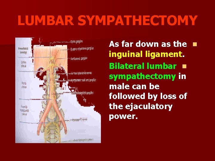 LUMBAR SYMPATHECTOMY As far down as the n inguinal ligament. Bilateral lumbar n sympathectomy