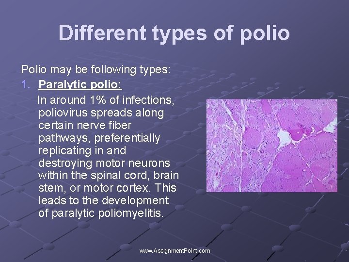 Different types of polio Polio may be following types: 1. Paralytic polio: In around