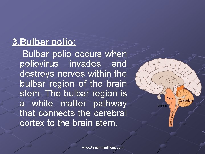 3. Bulbar polio: Bulbar polio occurs when poliovirus invades and destroys nerves within the