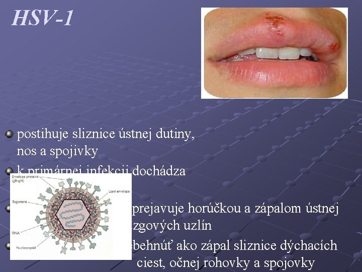 HSV-1 postihuje sliznice ústnej dutiny, nos a spojivky k primárnej infekcii dochádza už v