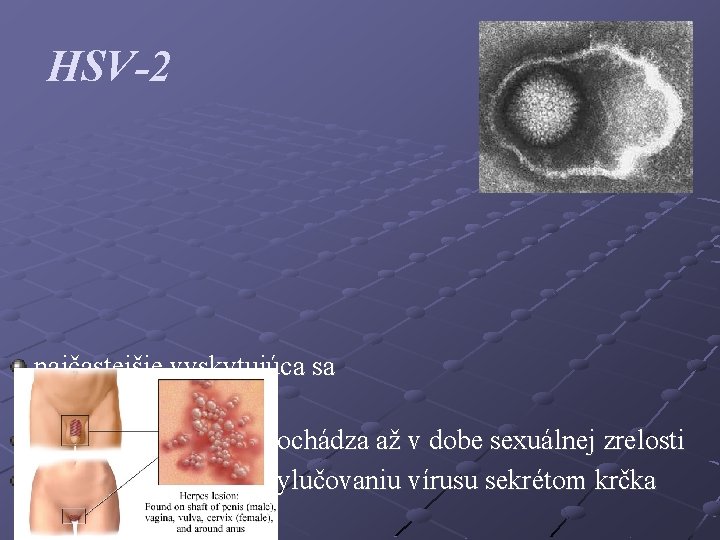 HSV-2 najčastejšie vyskytujúca sa pohlavná nákaza k primárnej infekcii dochádza až v dobe sexuálnej