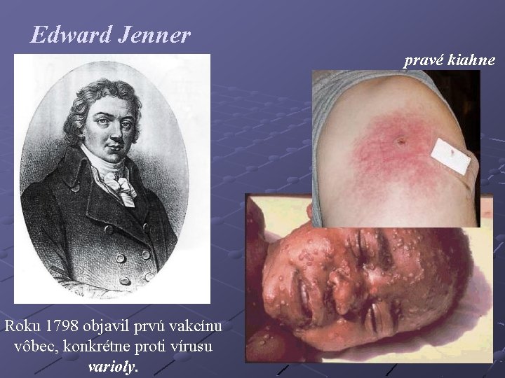 Edward Jenner pravé kiahne Roku 1798 objavil prvú vakcínu vôbec, konkrétne proti vírusu varioly.