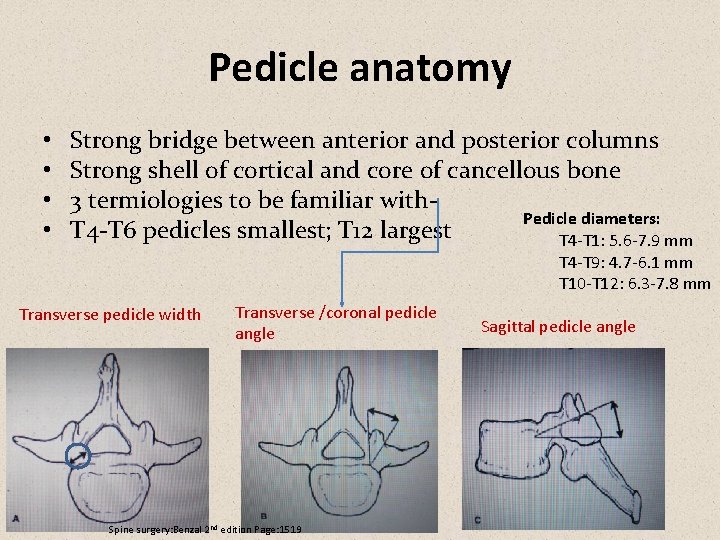 Pedicle anatomy • • Strong bridge between anterior and posterior columns Strong shell of