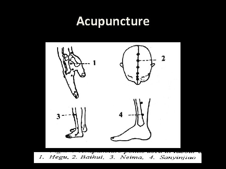 Acupuncture 
