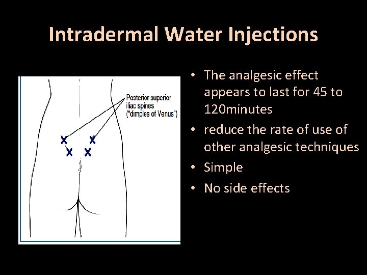 Intradermal Water Injections • The analgesic effect appears to last for 45 to 120