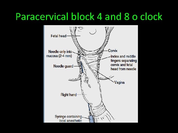 Paracervical block 4 and 8 o clock 