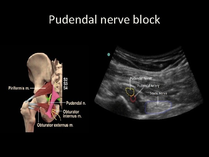Pudendal nerve block 