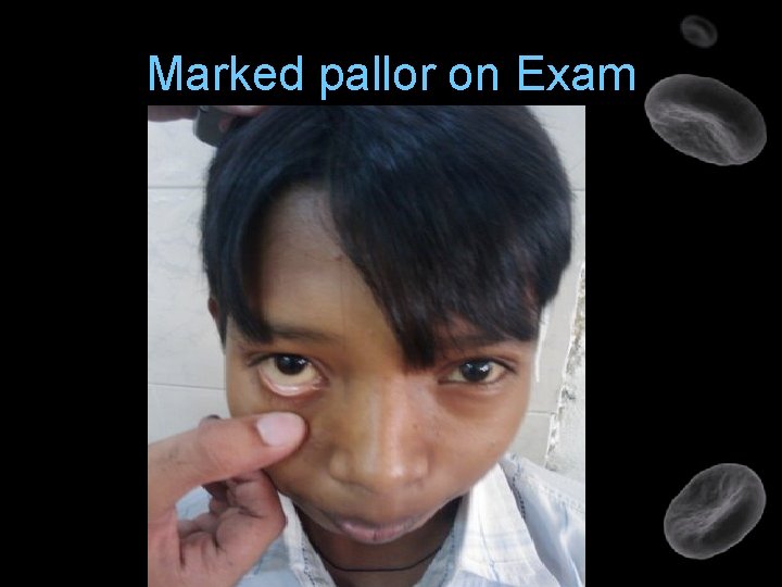Marked pallor on Exam 