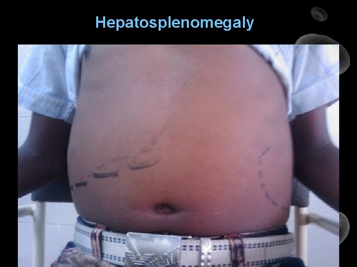 Hepatosplenomegaly 