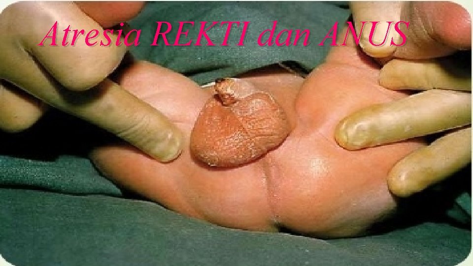 Atresia REKTI dan ANUS 