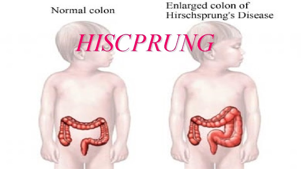 HISCPRUNG 