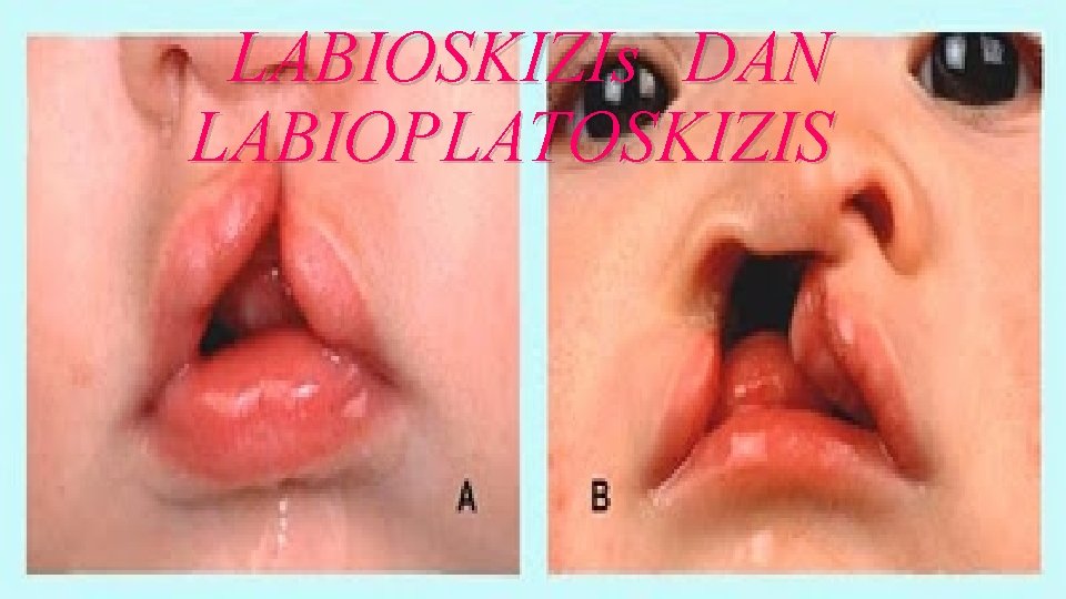 LABIOSKIZIs DAN LABIOPLATOSKIZIS 