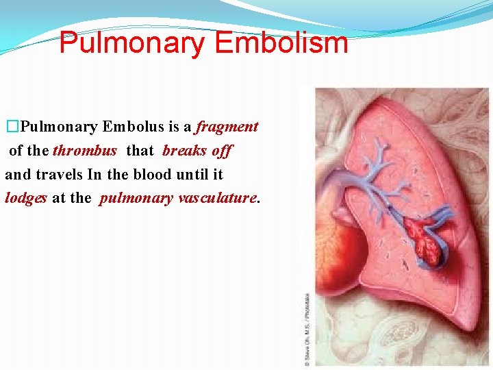 Pulmonary Embolism �Pulmonary Embolus is a fragment of the thrombus that breaks off and