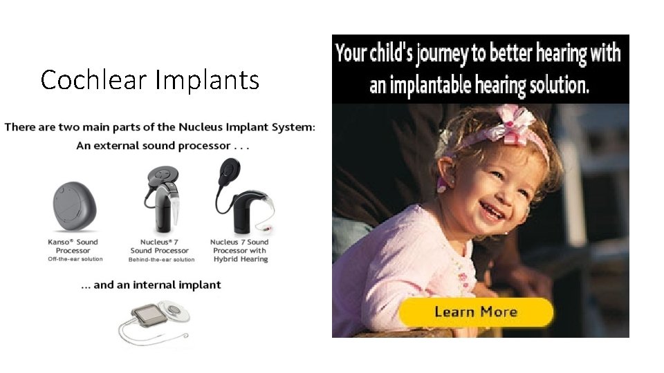 Cochlear Implants 