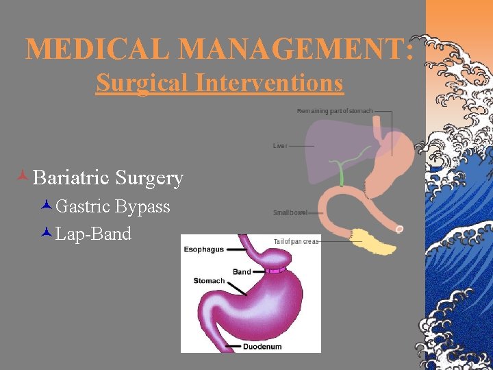 MEDICAL MANAGEMENT: Surgical Interventions ©Bariatric Surgery ©Gastric Bypass ©Lap-Band 