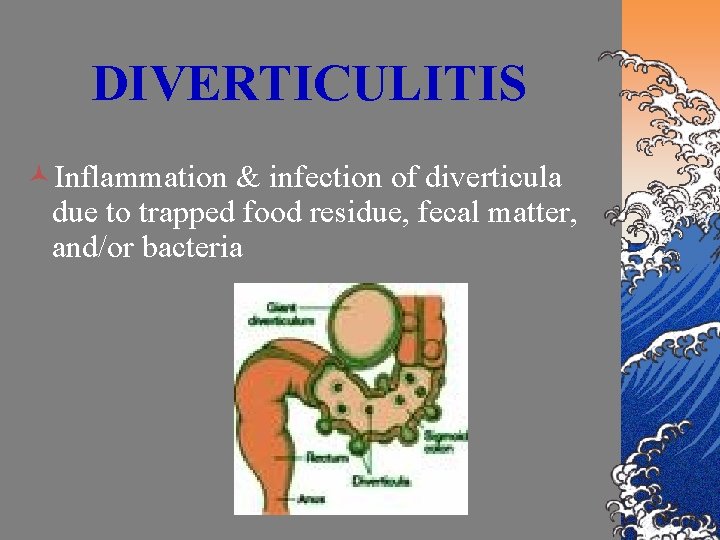 DIVERTICULITIS ©Inflammation & infection of diverticula due to trapped food residue, fecal matter, and/or
