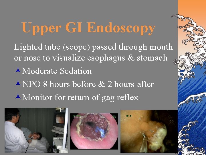 Upper GI Endoscopy Lighted tube (scope) passed through mouth or nose to visualize esophagus