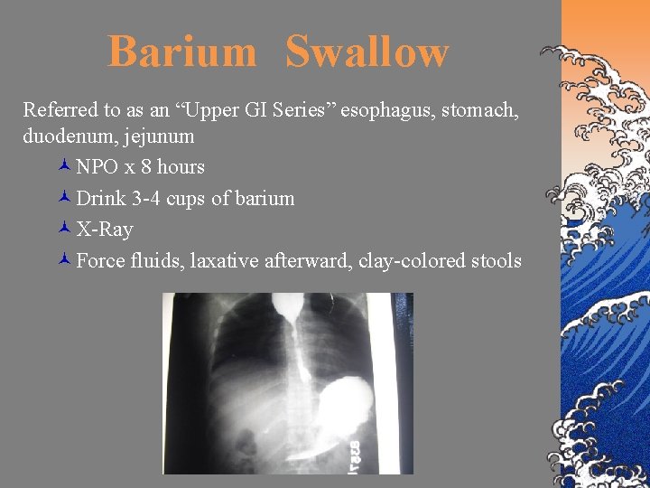 Barium Swallow Referred to as an “Upper GI Series” esophagus, stomach, duodenum, jejunum ©NPO