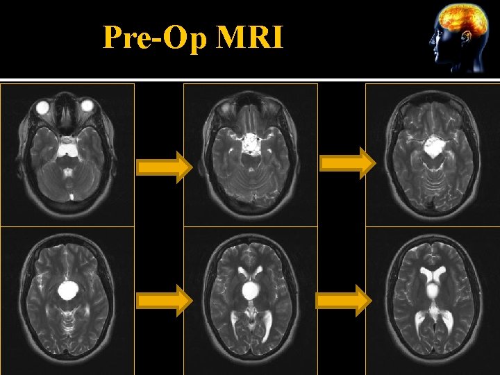 Pre-Op MRI 