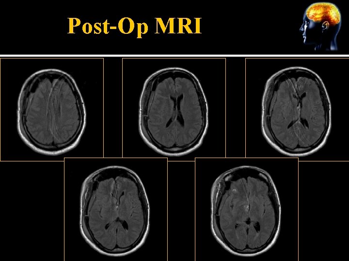 Post-Op MRI 