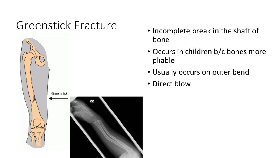 Greenstick Fracture • Incomplete break in the shaft of bone • Occurs in children