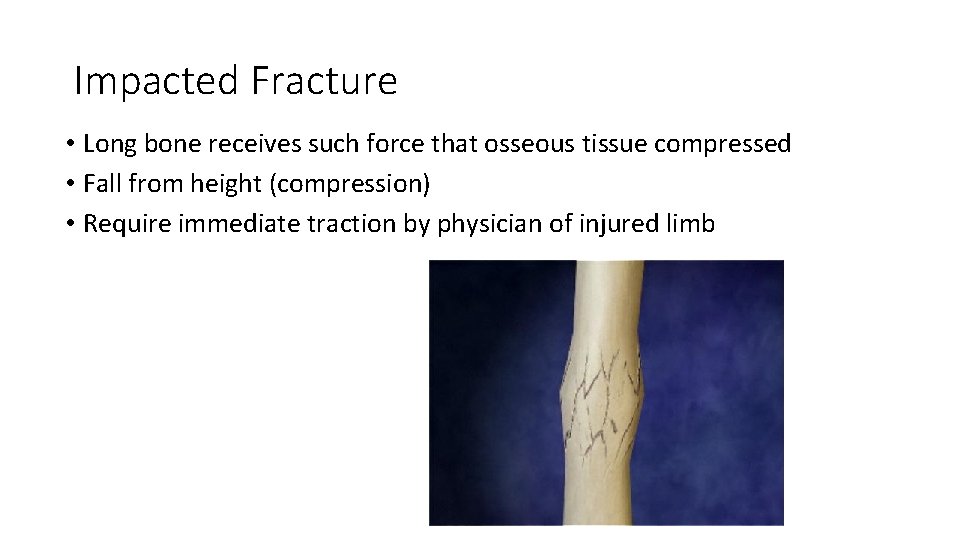 Impacted Fracture • Long bone receives such force that osseous tissue compressed • Fall