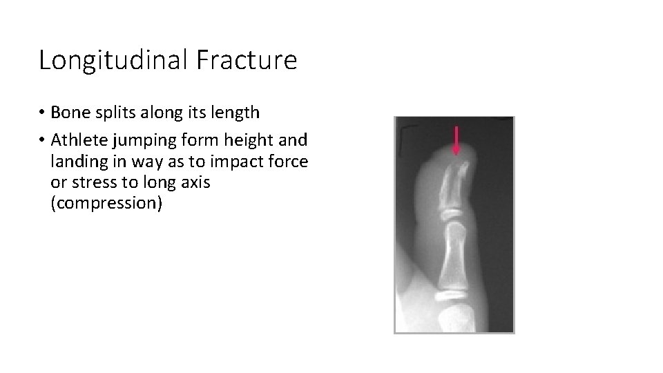 Longitudinal Fracture • Bone splits along its length • Athlete jumping form height and