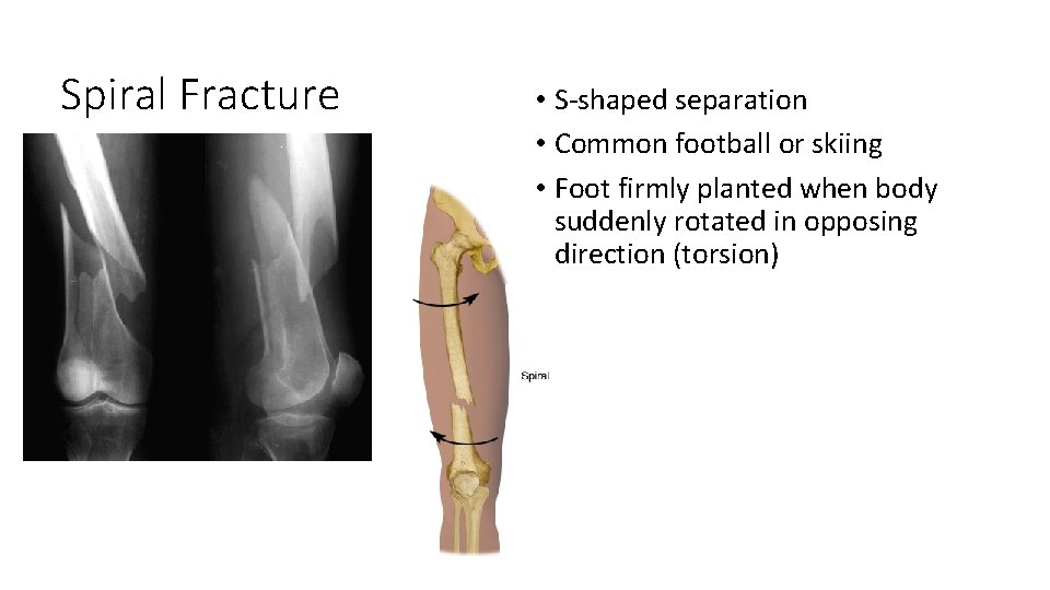 Spiral Fracture • S-shaped separation • Common football or skiing • Foot firmly planted