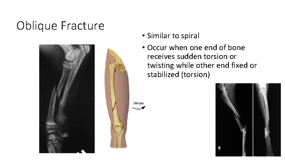 Oblique Fracture • Similar to spiral • Occur when one end of bone receives