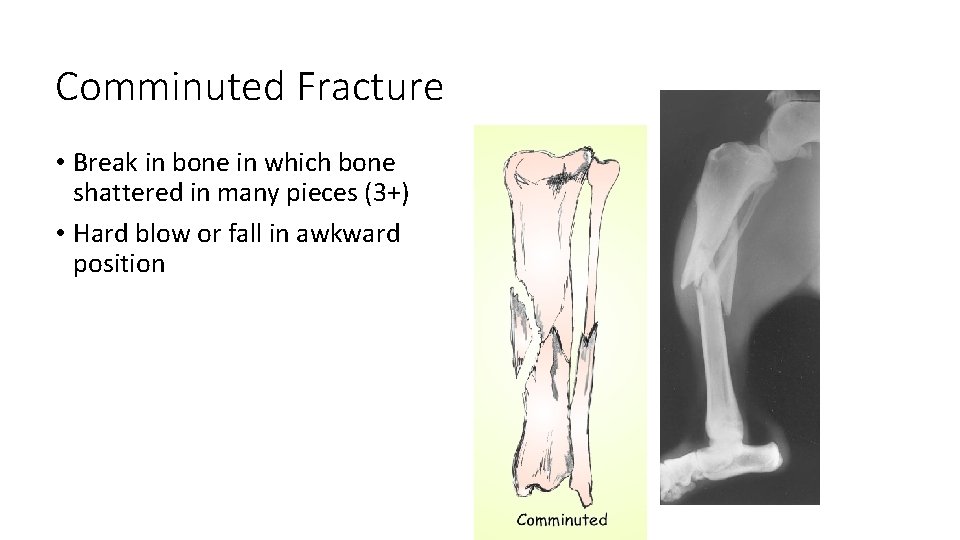 Comminuted Fracture • Break in bone in which bone shattered in many pieces (3+)