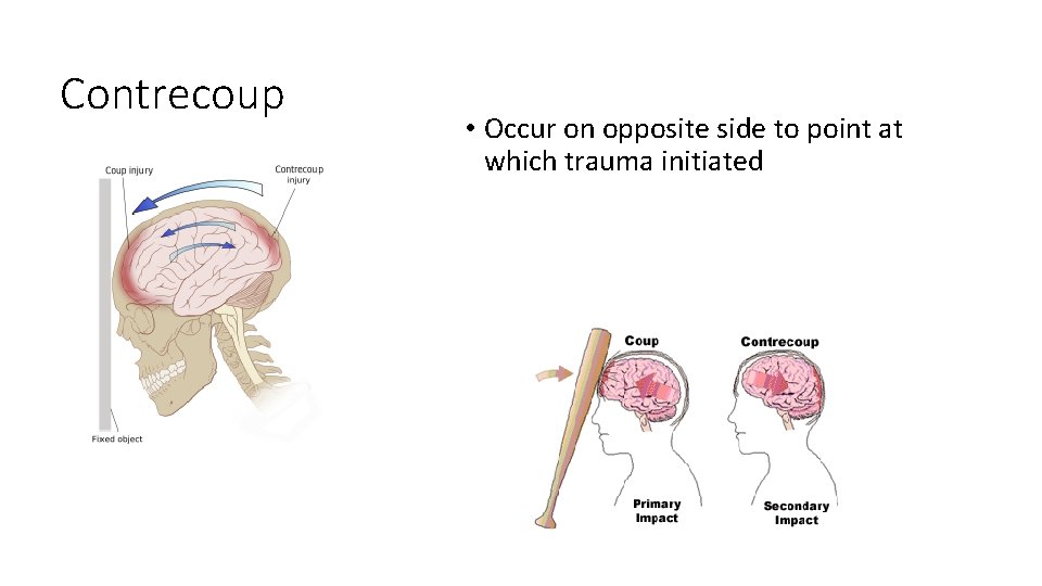 Contrecoup • Occur on opposite side to point at which trauma initiated 