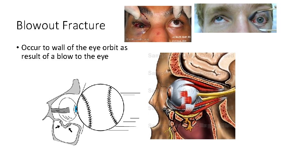 Blowout Fracture • Occur to wall of the eye orbit as result of a