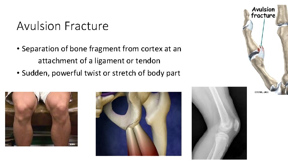 Avulsion Fracture • Separation of bone fragment from cortex at an attachment of a