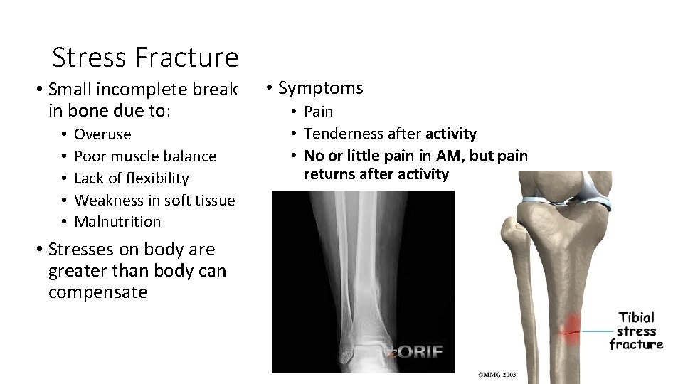 Stress Fracture • Small incomplete break in bone due to: • • • Overuse