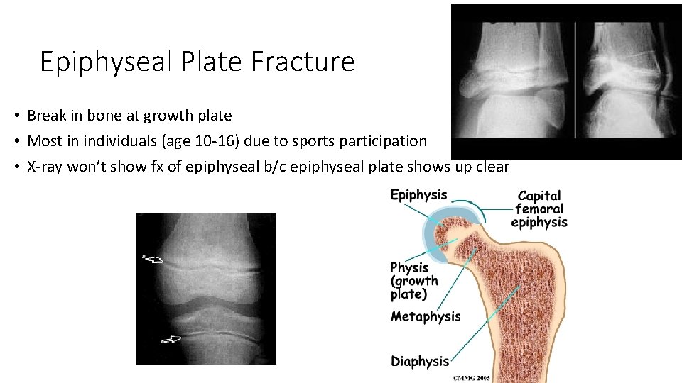 Epiphyseal Plate Fracture • Break in bone at growth plate • Most in individuals
