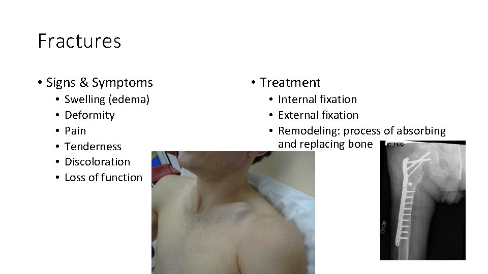 Fractures • Signs & Symptoms • • • Swelling (edema) Deformity Pain Tenderness Discoloration