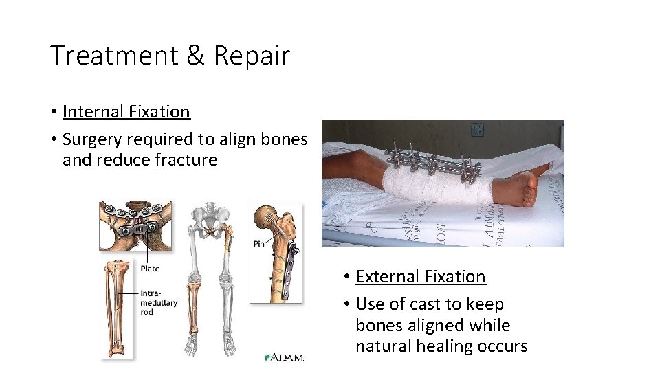 Treatment & Repair • Internal Fixation • Surgery required to align bones and reduce