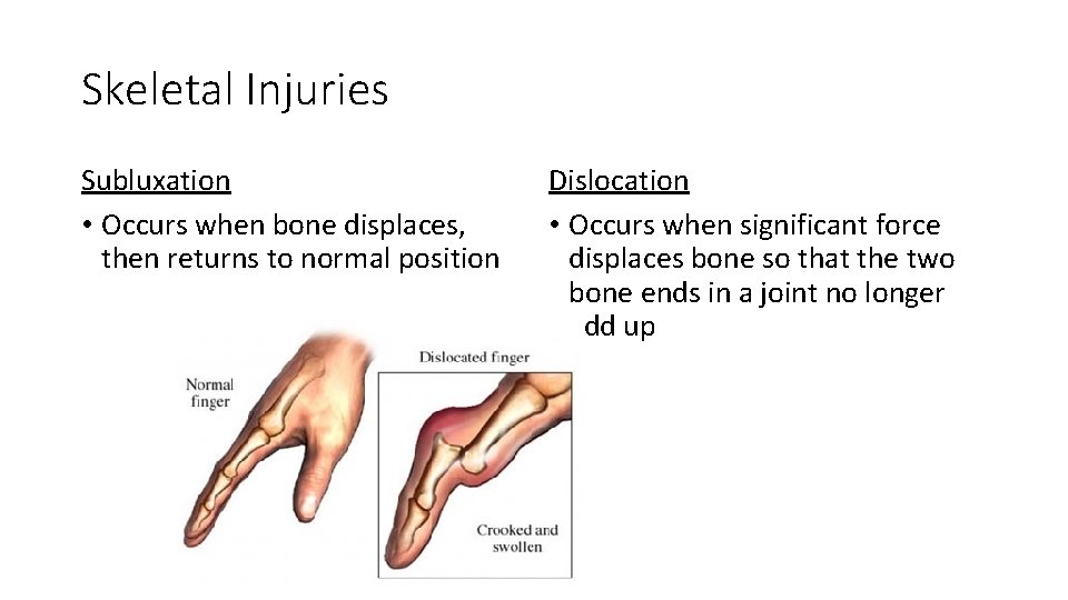 Skeletal Injuries Subluxation • Occurs when bone displaces, then returns to normal position Dislocation
