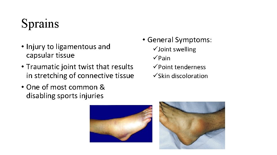 Sprains • Injury to ligamentous and capsular tissue • Traumatic joint twist that results