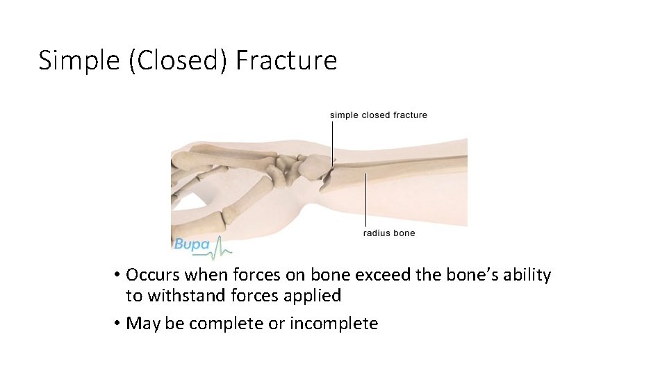 Simple (Closed) Fracture • Occurs when forces on bone exceed the bone’s ability to