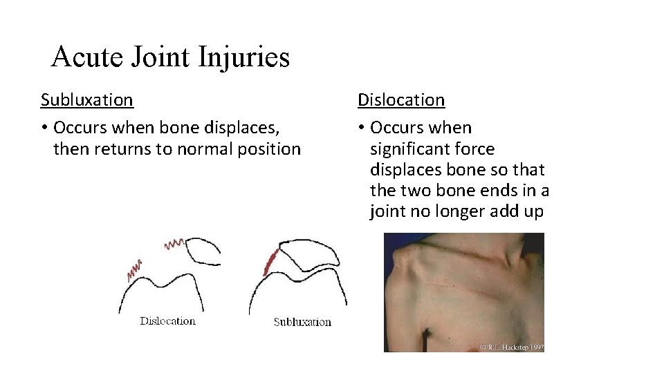 Acute Joint Injuries Subluxation • Occurs when bone displaces, then returns to normal position