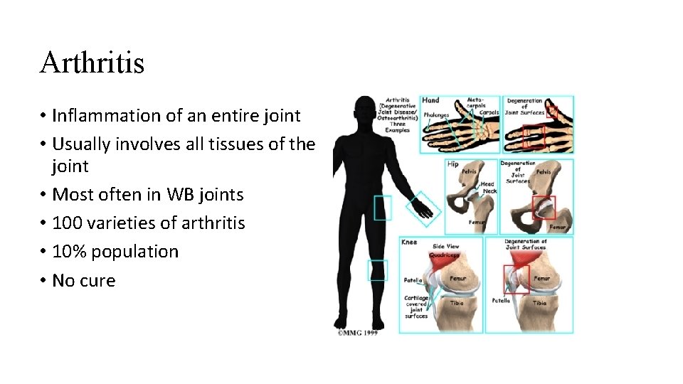 Arthritis • Inflammation of an entire joint • Usually involves all tissues of the